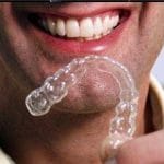 Perfect Smile With Clear Braces and Teeth Whitening
